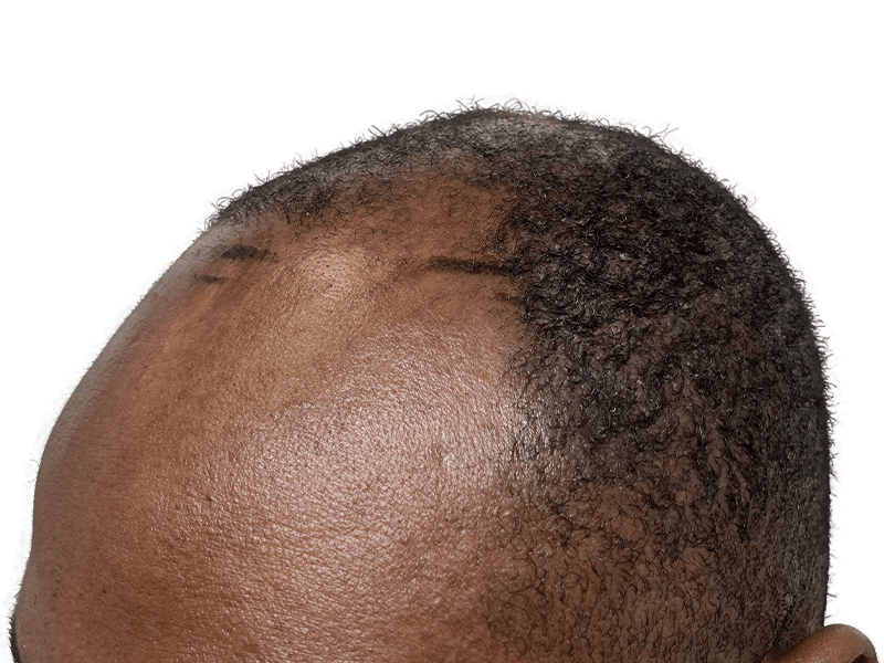 Hair transplant result: African American man's hairline restored. Before/after visible. Hair restoration success.