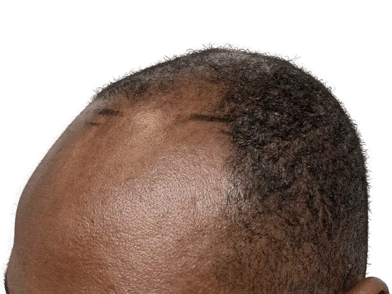 Hair transplant result: African American man's hairline restored. Before/after visible. Hair restoration success.