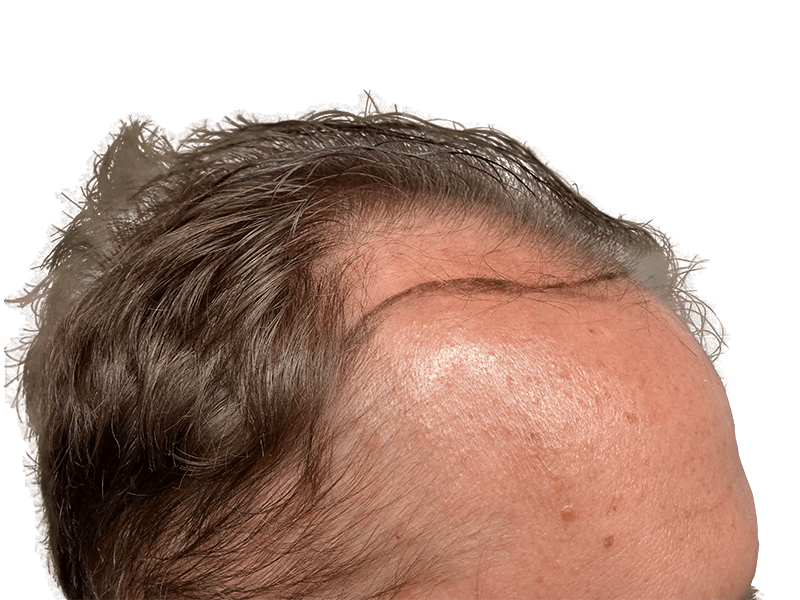 Hair transplant result: Receding hairline restored. Before & after showing fuller, natural-looking hair. Male, graying hair.