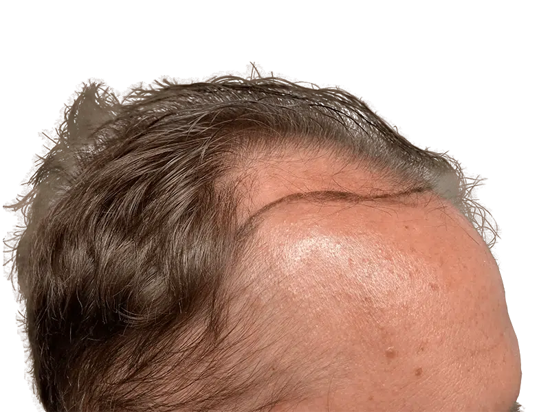 Hair transplant result: Receding hairline restored. Before & after showing fuller, natural-looking hair. Male, graying hair.