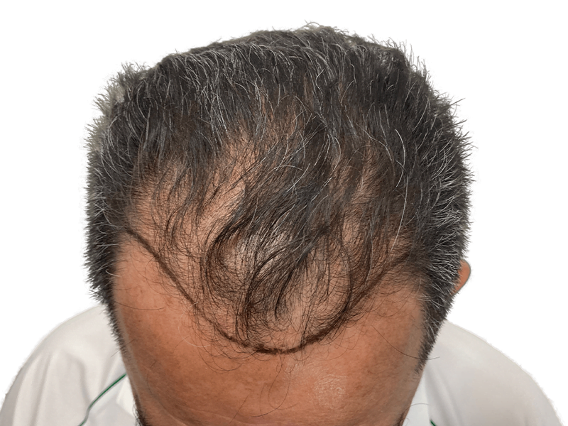 Hair transplant result: New hair growth along receding hairline. Before & after hair restoration procedure. Gray & brown hair.