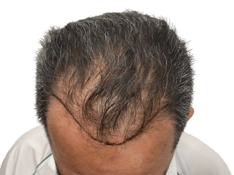 Hair transplant result: New hair growth along receding hairline. Before & after hair restoration procedure. Gray & brown hair.