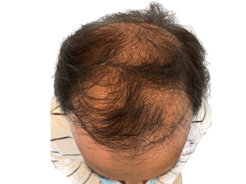 Thinning hair at crown. Possible hair loss. Consider hair restoration or hair transplant options. Before treatment example.