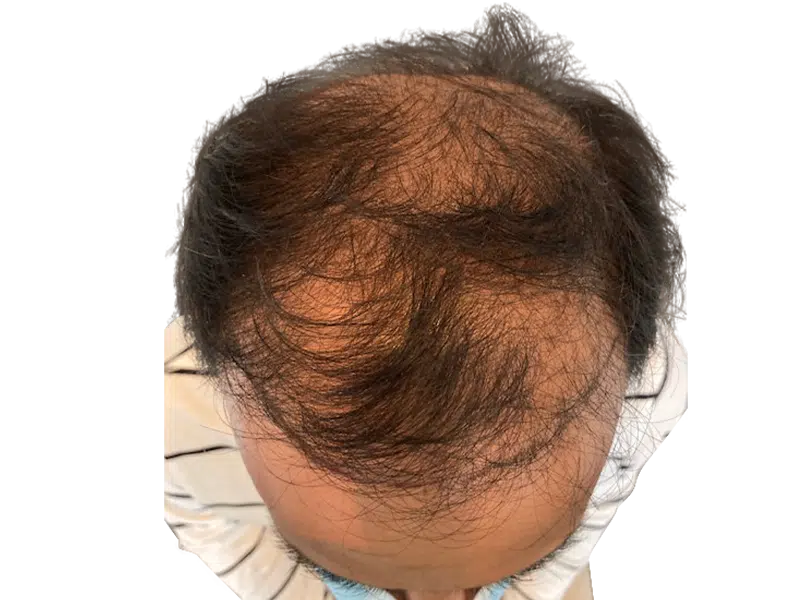 Thinning hair at crown. Possible hair loss. Consider hair restoration or hair transplant options. Before treatment example.