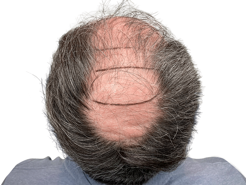 Before hair transplant: Thinning hair, receding hairline marked for hair restoration. Graying hair & beard visible.