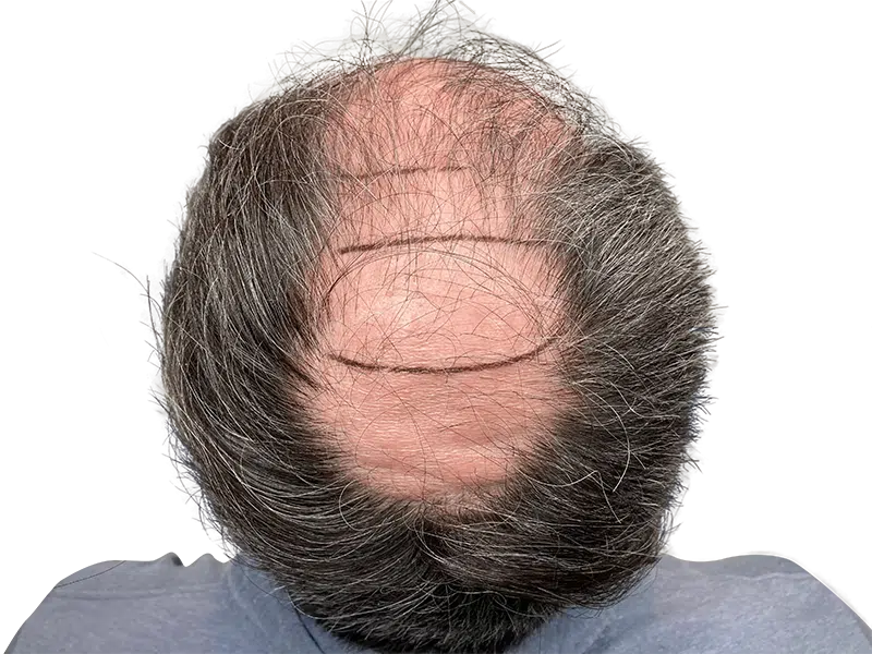 Before hair transplant: Thinning hair, receding hairline marked for hair restoration. Graying hair & beard visible.