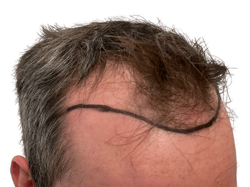 Hair transplant planning: Marked hairline on forehead before hair restoration. Thinning, receding hair. Caucasian male.