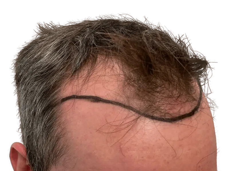 Hair transplant planning: Marked hairline on forehead before hair restoration. Thinning, receding hair. Caucasian male.