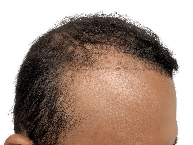 Hair transplant before & after: Restored hairline with denser growth. Faint scar visible. Hair restoration results.