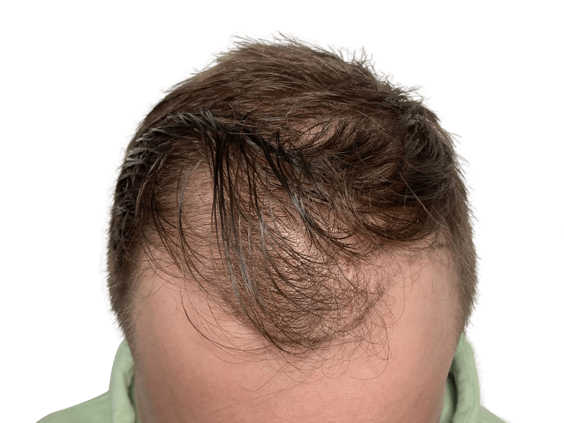 Thinning brown hair, receding hairline. Hair restoration consultation? Consider hair transplant options.