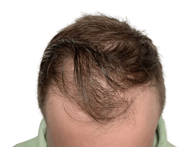 Thinning brown hair, receding hairline. Hair restoration consultation? Consider hair transplant options.