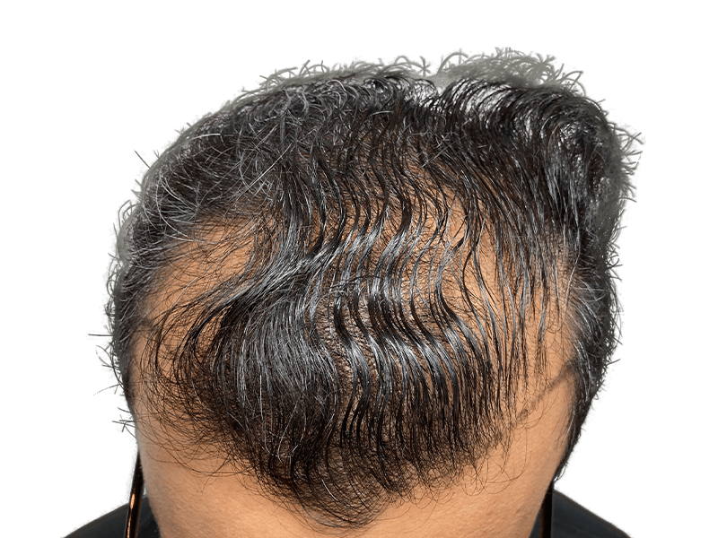 Thinning dark hair at hairline. Potential hair loss candidate. Consider hair restoration or transplant options.