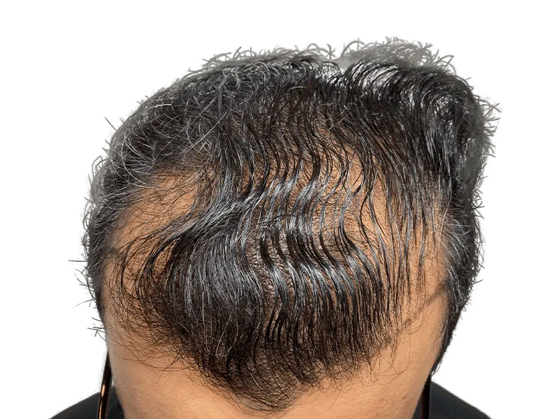 Thinning dark hair at hairline. Potential hair loss candidate. Consider hair restoration or transplant options.