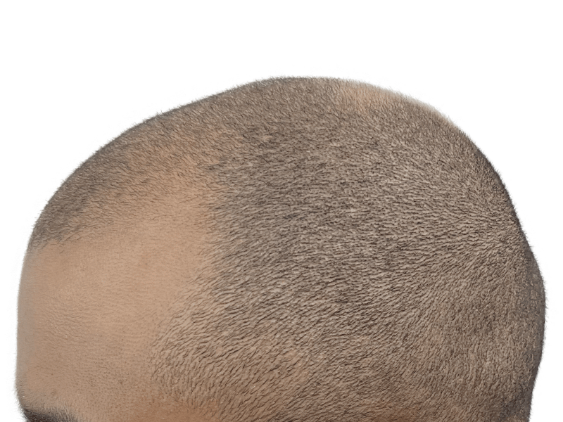 Thinning hair, visible scalp. Potential hair transplant candidate. Hair restoration before/after assessment.