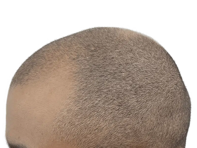 Thinning hair, visible scalp. Potential hair transplant candidate. Hair restoration before/after assessment.