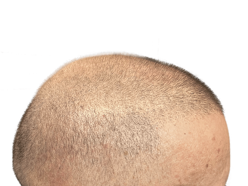 Healthy, dense hair on scalp. Possible hair restoration result. Hair transplant evaluation. Before/after assessment.