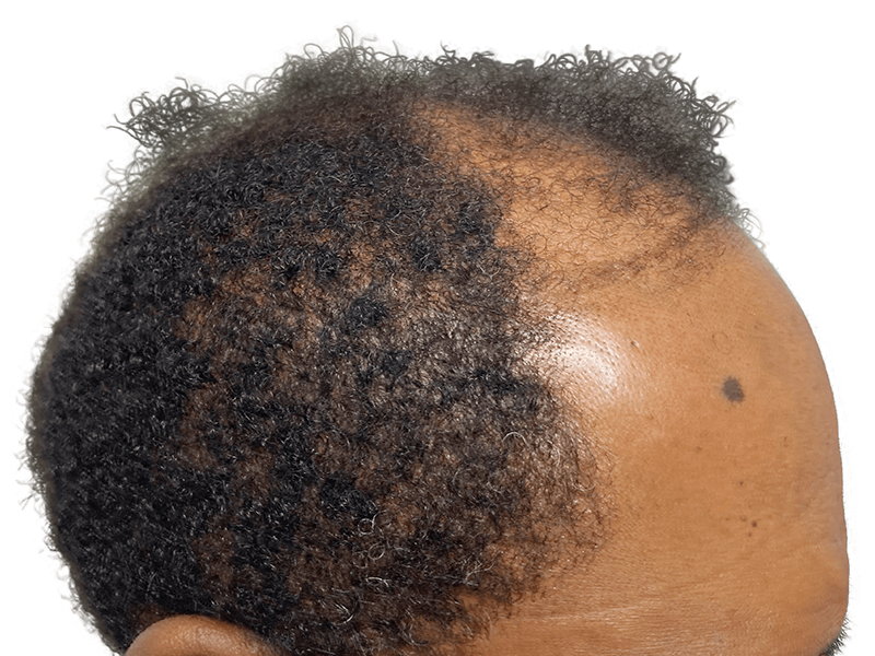 Receding hairline before hair restoration. Dark, curly hair with thinning. Potential hair transplant candidate.
