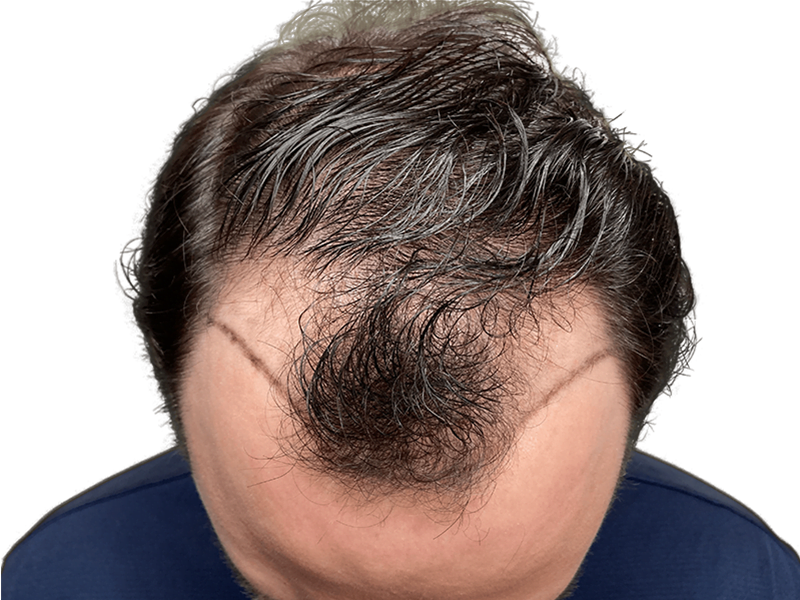 Hair transplant result: New hairline with denser hair growth. Before/after visible. Hair restoration procedure.