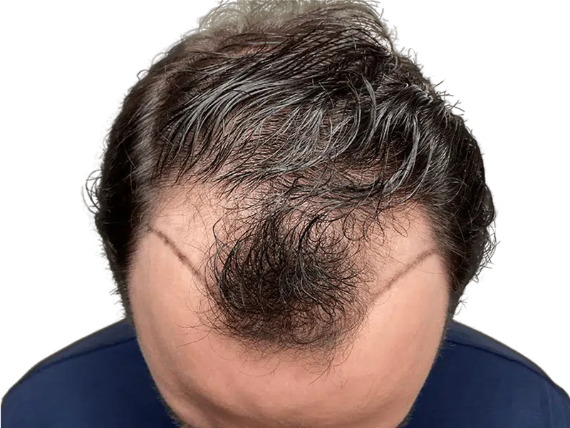 Hair transplant result: New hairline with denser hair growth. Before/after visible. Hair restoration procedure.
