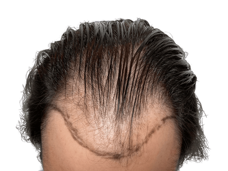 Hair transplant before & after: receding hairline restored. See fuller, denser hair after hair restoration procedure.