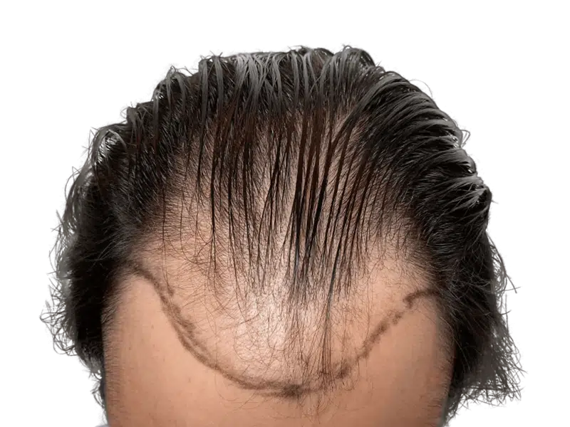 Hair transplant before & after: receding hairline restored. See fuller, denser hair after hair restoration procedure.