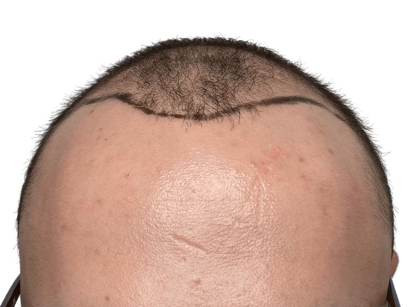 Receding hairline marked for hair transplant. Before hair restoration procedure. See potential results.
