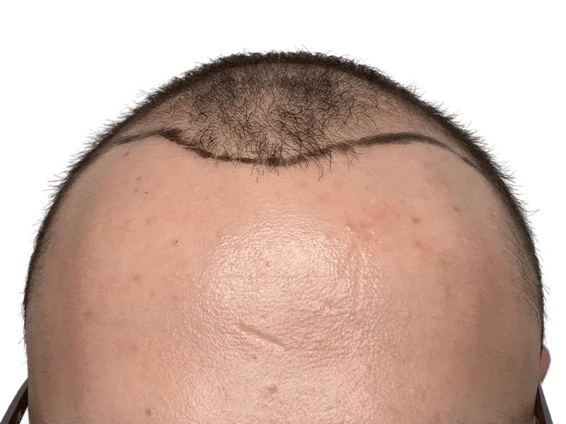 Receding hairline marked for hair transplant. Before hair restoration procedure. See potential results.