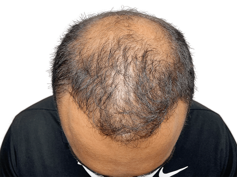 Before hair transplant: Man with thinning hair and balding crown. Hair restoration candidate.