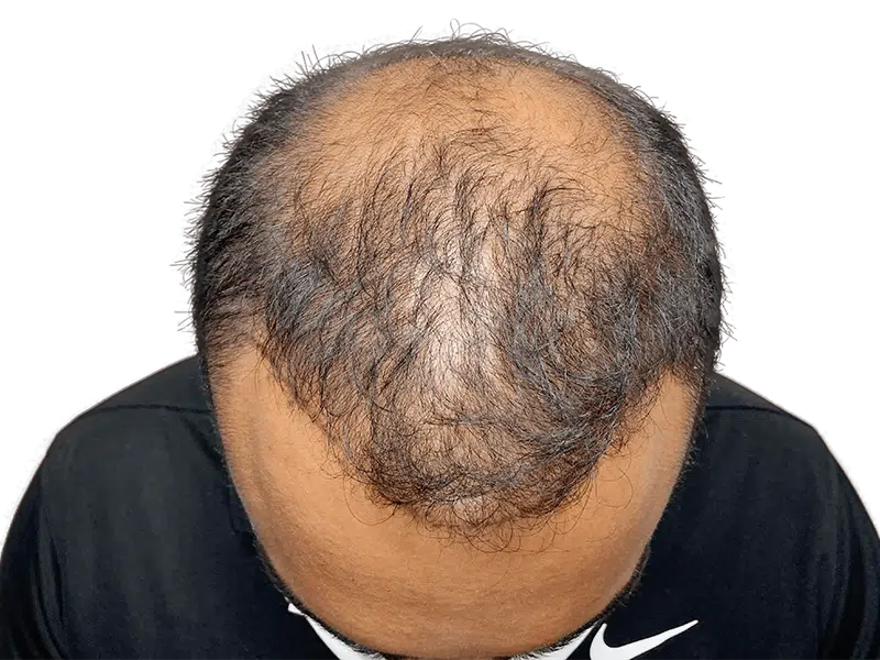 Before hair transplant: Man with thinning hair and balding crown. Hair restoration candidate.