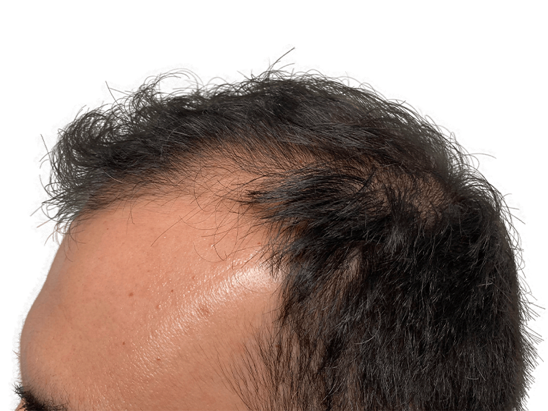 Thinning hairline before hair restoration. Dark hair, receding. Potential hair transplant candidate. Before & after results.