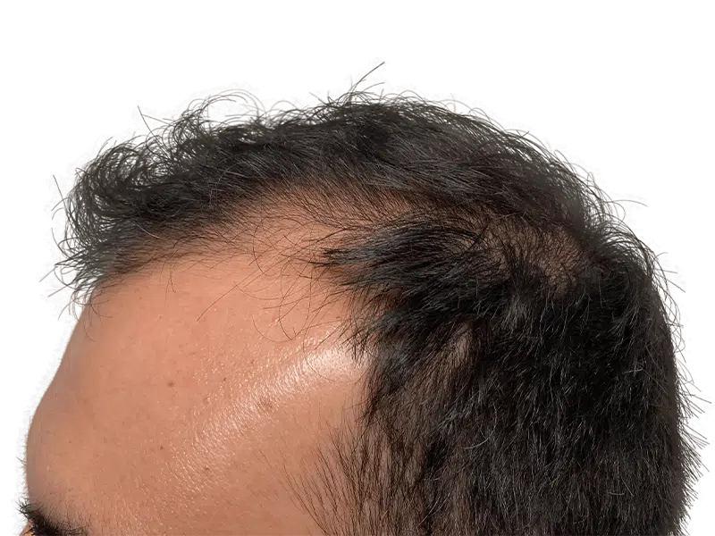 Thinning hairline before hair restoration. Dark hair, receding. Potential hair transplant candidate. Before & after results.