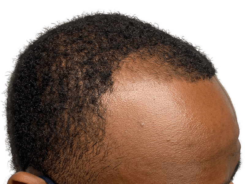 Hair thinning in African American man. Before hair transplant. Hair restoration candidate. Receding hairline.