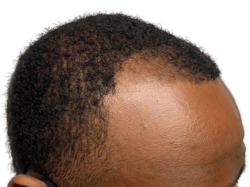 Hair thinning in African American man. Before hair transplant. Hair restoration candidate. Receding hairline.