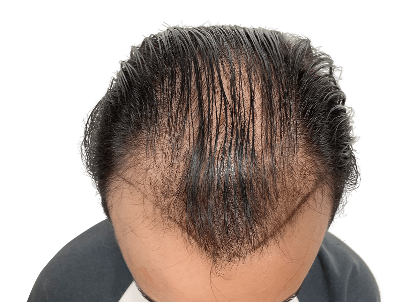 Hair transplant result: Asian man's hairline showing new growth after procedure. Before & after hair restoration.