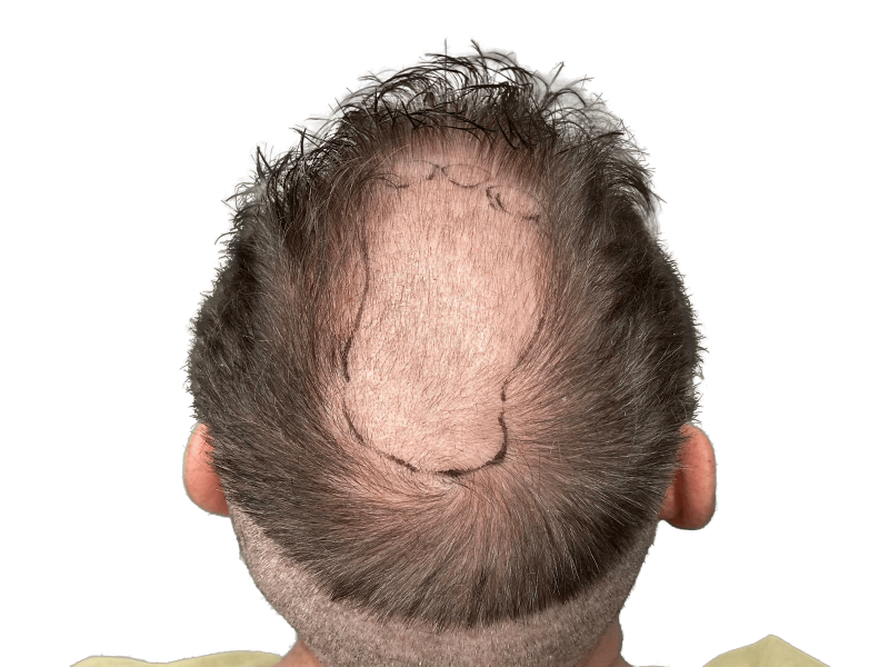 Before hair transplant: Man's crown with marked hair loss area. Hair restoration candidate. Shows balding before procedure.