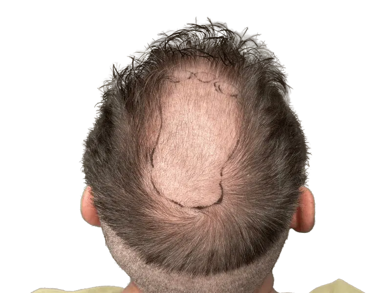 Before hair transplant: Man's crown with marked hair loss area. Hair restoration candidate. Shows balding before procedure.