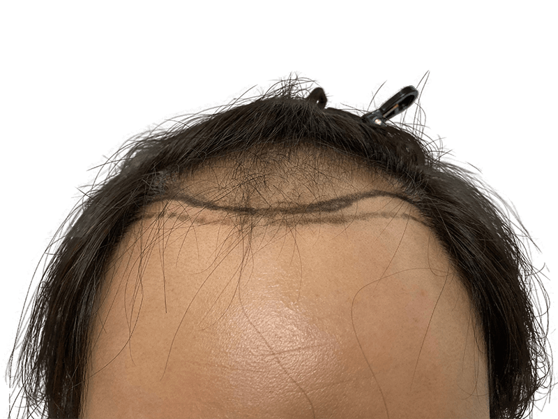 Before hair transplant: Marked hairline on dark-haired man. Hair restoration consultation. Thinning hair visible.
