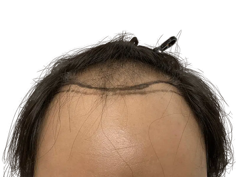 Before hair transplant: Marked hairline on dark-haired man. Hair restoration consultation. Thinning hair visible.