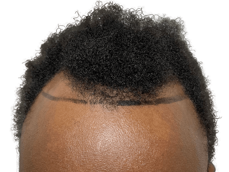 Hair transplant hairline design on African American man. Shows planned hair restoration results. Before/after concept.