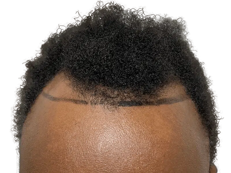 Hair transplant hairline design on African American man. Shows planned hair restoration results. Before/after concept.