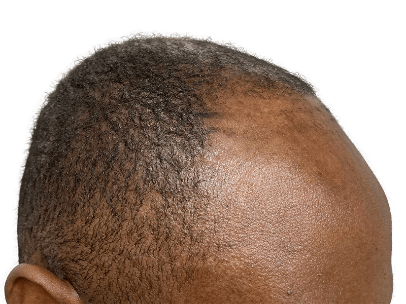 Receding hairline in Black man. Before hair transplant. Hair restoration candidate. Side view of balding head.