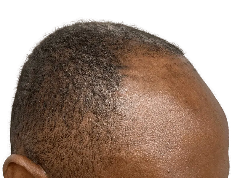 Receding hairline in Black man. Before hair transplant. Hair restoration candidate. Side view of balding head.