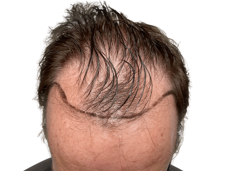 Hair transplant before & after. Marked hairline for hair restoration procedure. See hair density improvement.