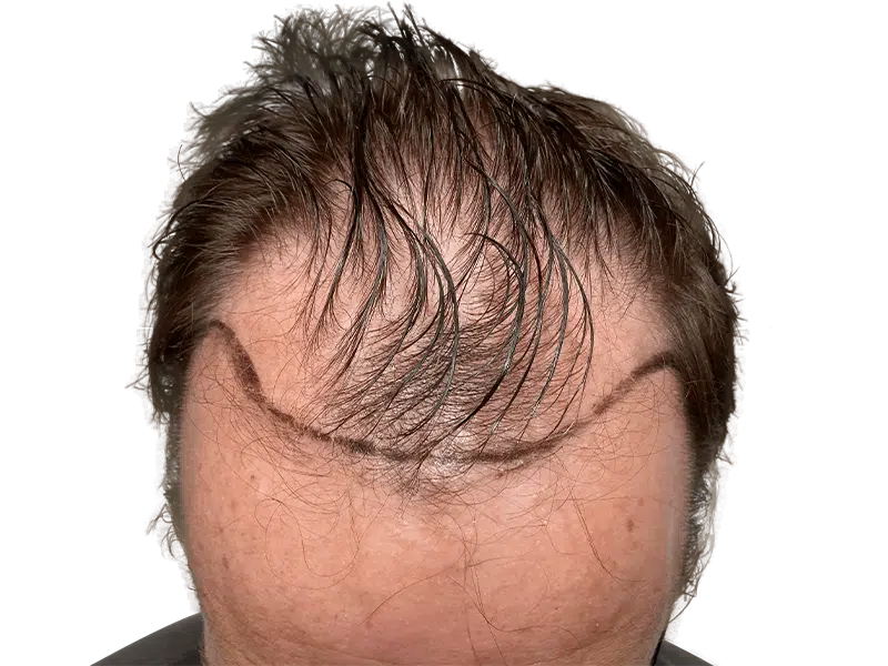Hair transplant before & after. Marked hairline for hair restoration procedure. See hair density improvement.