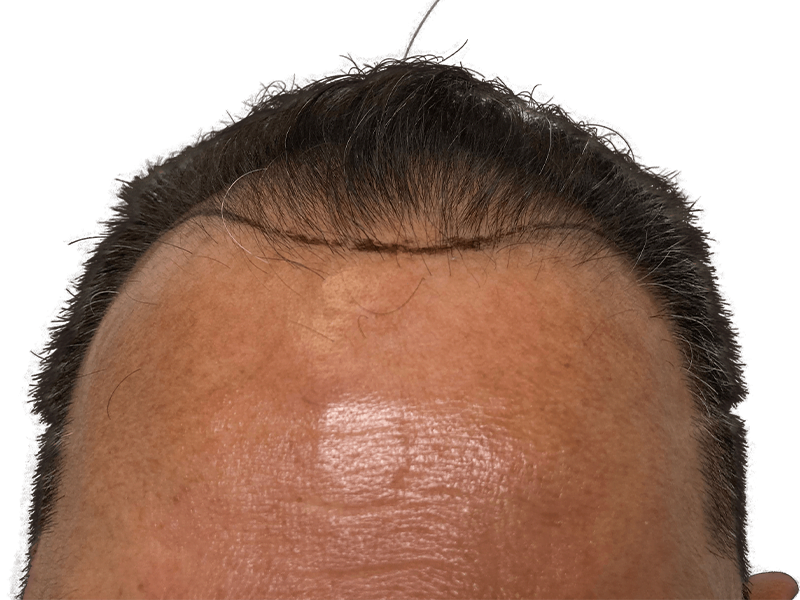 Hair transplant before/after. Man's hairline close-up. Hair restoration results, Caucasian male.