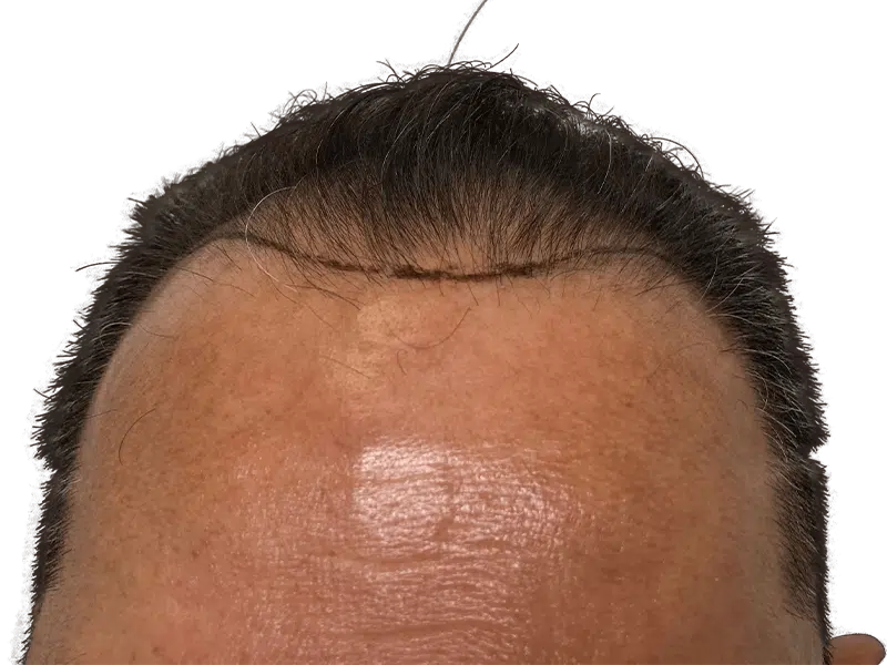 Hair transplant before/after. Man's hairline close-up. Hair restoration results, Caucasian male.