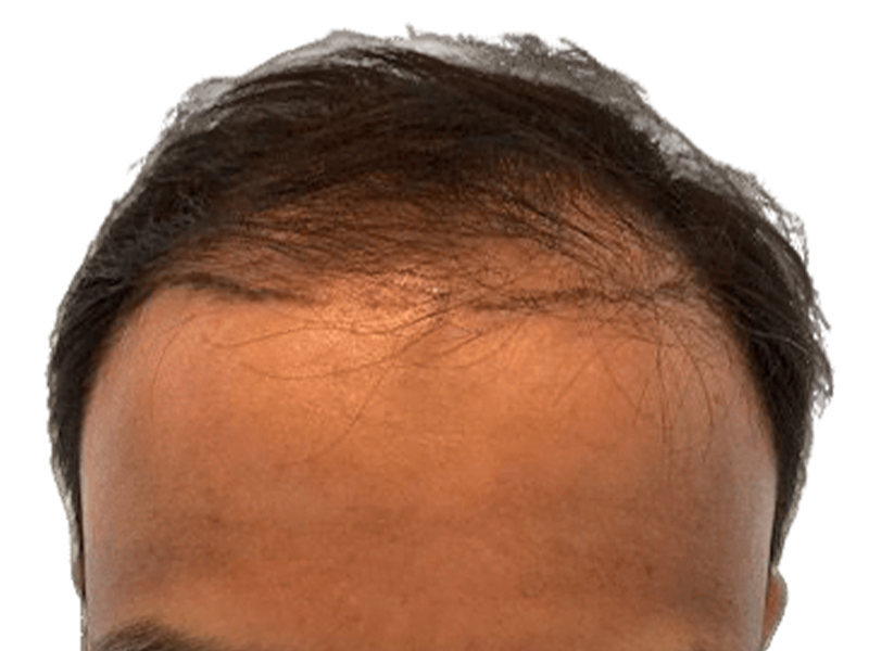 Receding hairline before hair transplant. Dark hair, thinning at the front. Hair restoration candidate.