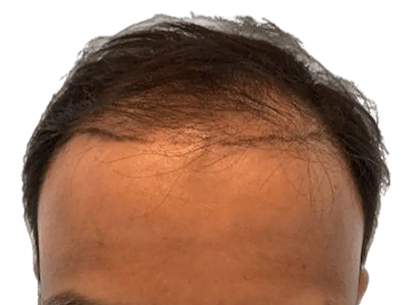 Receding hairline before hair transplant. Dark hair, thinning at the front. Hair restoration candidate.