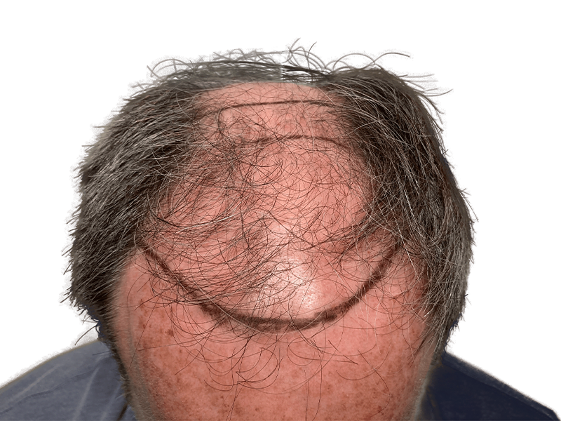 Before hair transplant: Balding man with receding hairline. Scalp marked for hair restoration procedure.