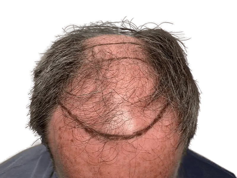 Before hair transplant: Balding man with receding hairline. Scalp marked for hair restoration procedure.